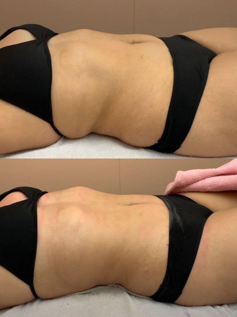Client abdomen before and after a course of cryotherapy