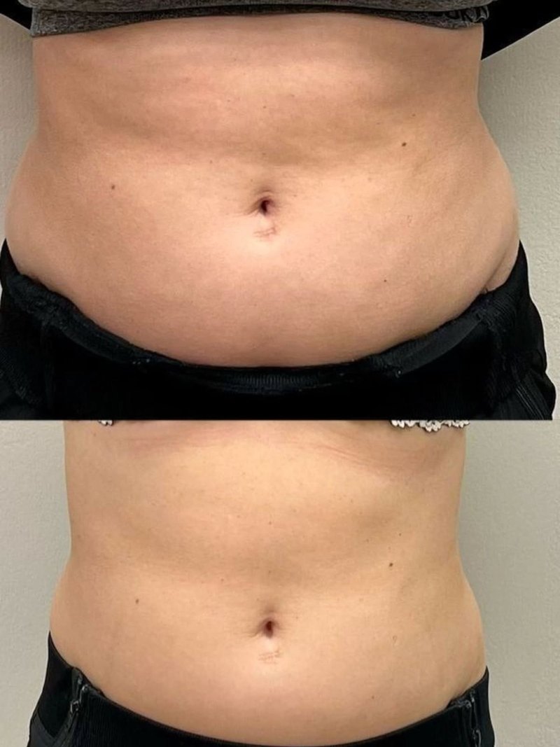 Client waist before and after a course of cryotherapy