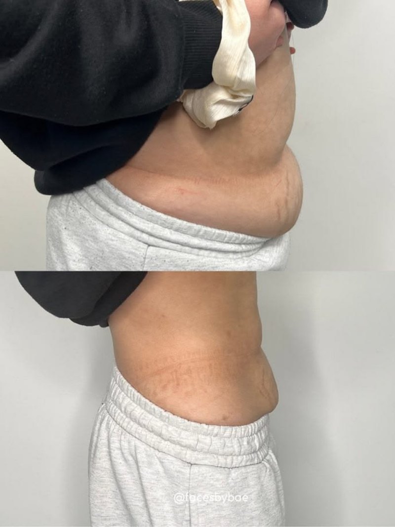Client midsection before and after a course of cryotherapy