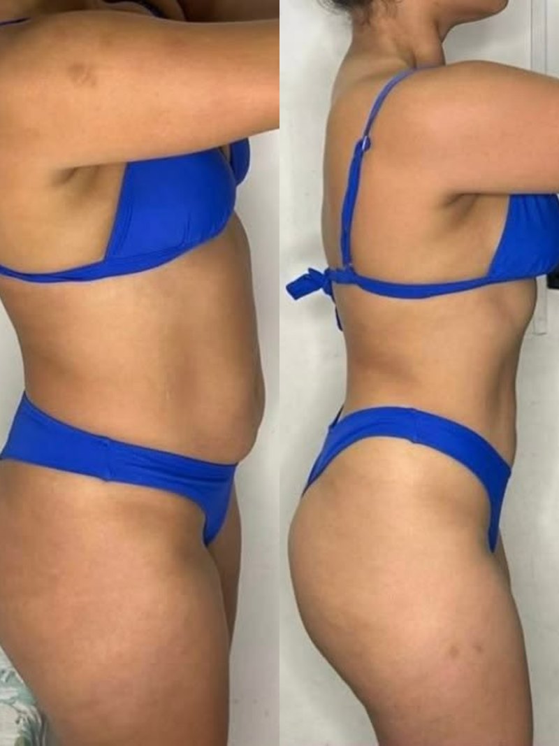 Client side profile before and after a course of cryotherapy