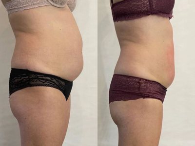 Client abdomen before and after endosphere therapy