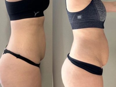 Client waist before and after endosphere therapy