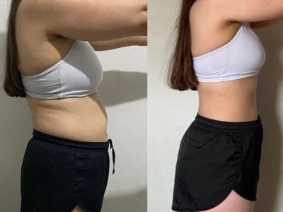 Client side profile before and after endosphere therapy