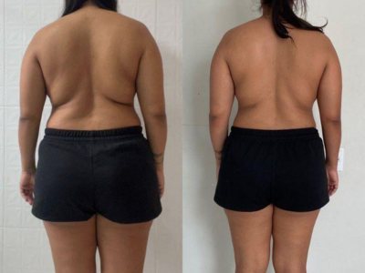 Client back before and after endosphere therapy