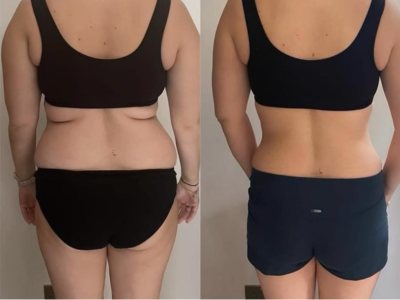 Client back before and after endosphere therapy
