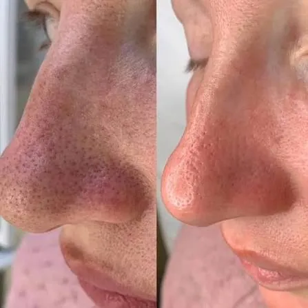 Before and after — Deep Cleansing Facial