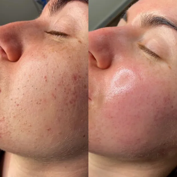Before and after — Hydrating Facial